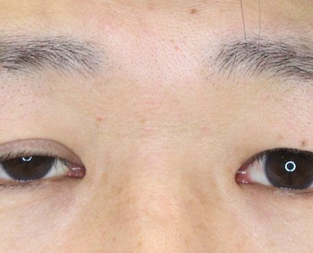 片目の眼瞼下垂症手術 男性編 麗ビューティーブログ