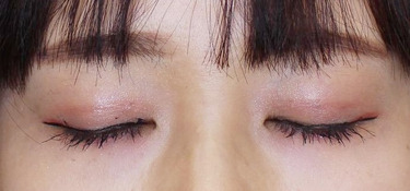 平行型の華やかな二重を二重埋没法で 麗ビューティーブログ 平行型の華やかな二重を二重埋没法で 麗ビューティーブログ