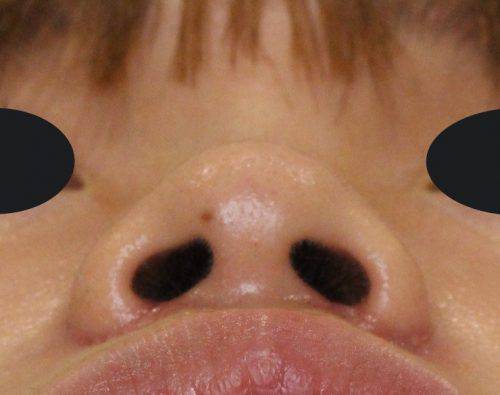 鼻翼縮小術 鼻の穴は小さくしたくない編 麗ビューティーブログ