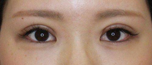 二重全切開で平行型の二重を 麗ビューティーブログ 二重全切開で平行型の二重を 麗ビューティーブログ
