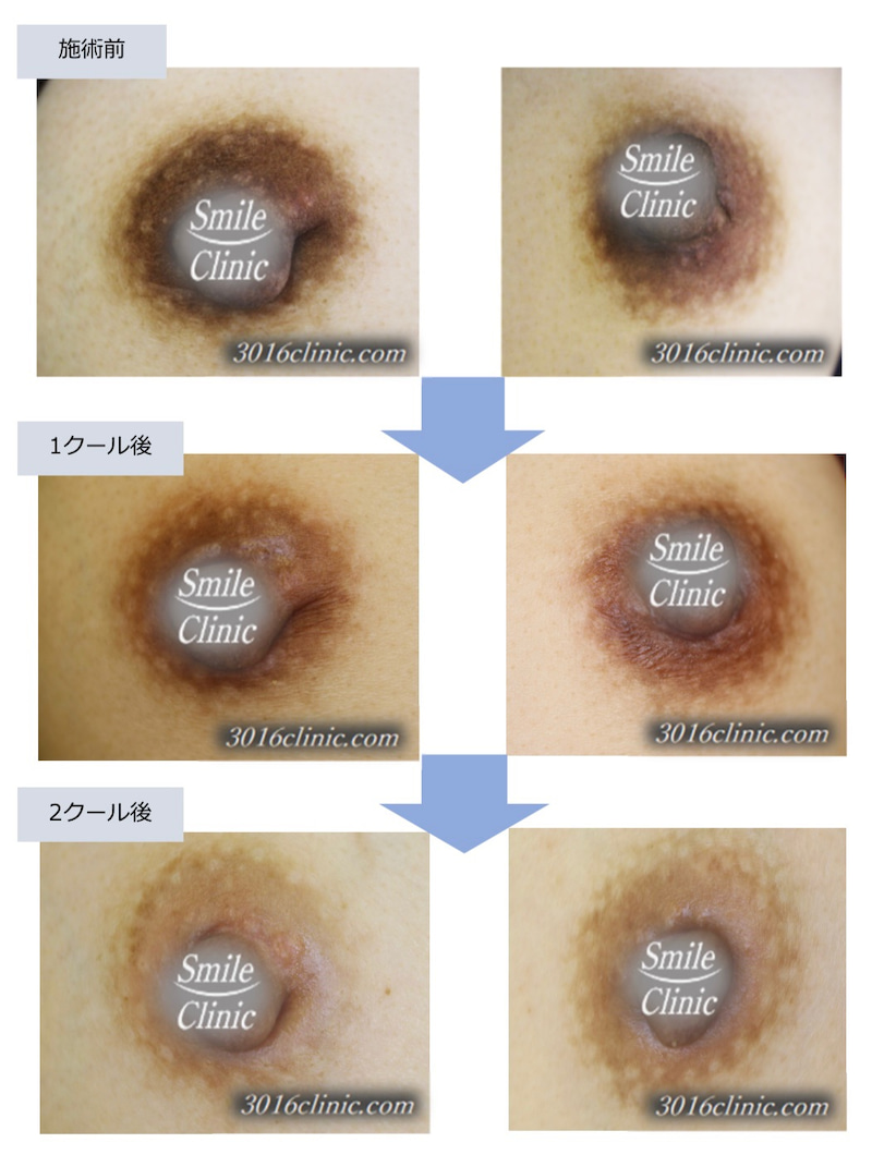 乳首 の 黒ずみ